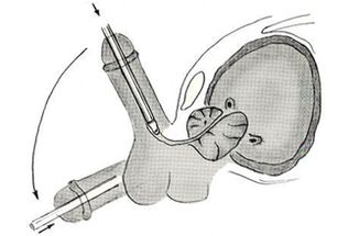 Schema di intervento chirurgico per l'ingrandimento del pene endoscopico