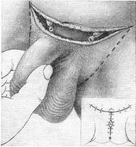 Allungamento chirurgico del pene estraendo la sua parte nascosta