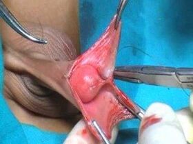 Chirurgia dell'ingrandimento del pene maschile